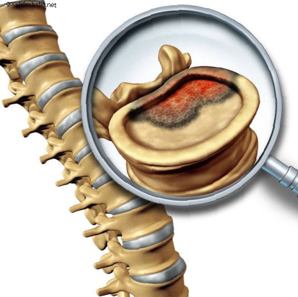 El condrosarcoma espinal es un cáncer de hueso primario