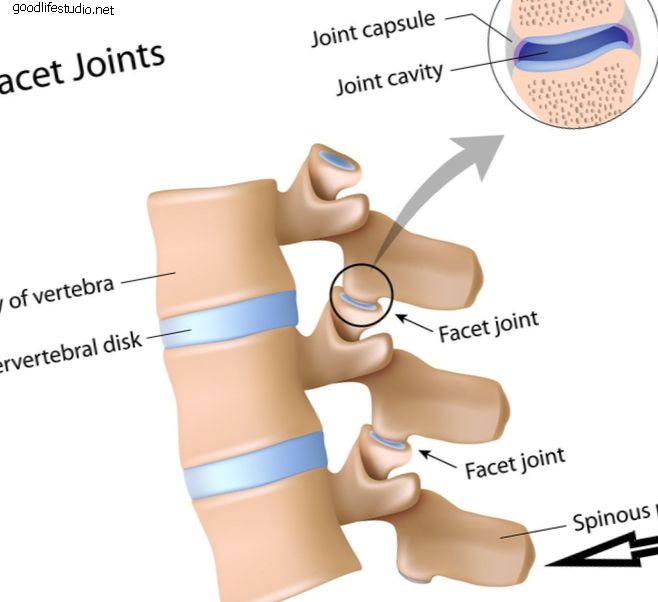 Signo de Baastrup (columna vertebral besándose) y dolor de espalda