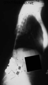 x-ray, ketidakseimbangan sagittal tetap