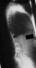 x-ray, ketidakseimbangan sagittal tetap
