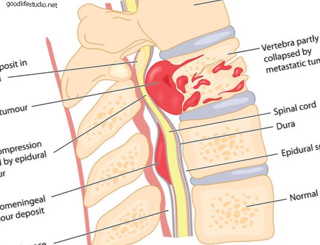 Cáncer y fracturas espinales