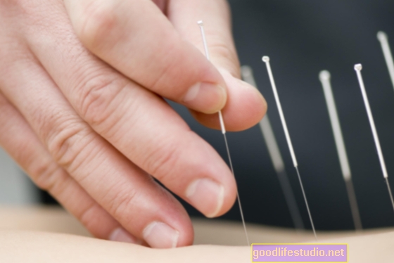 La acupuntura ofrece alivio del dolor a los niños con problemas médicos complejos