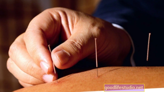 Akupunktur funktioniert genauso gut wie die Beratung bei Depressionen