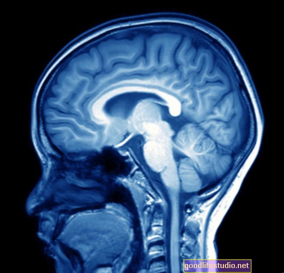 Napredni MRI pomaže predvidjeti pad pamćenja