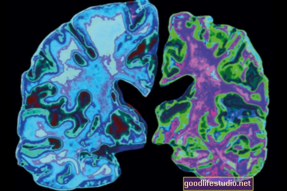 El gen de Alzheimer puede afectar la cognición antes de la edad adulta