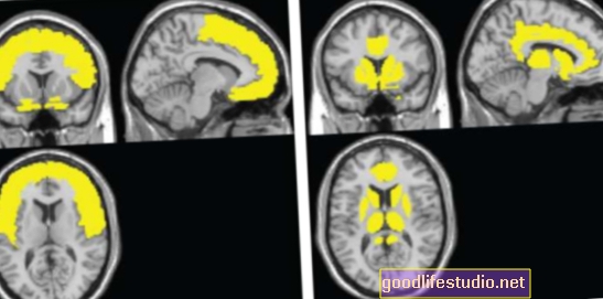 يساعد تصوير الدماغ في تشخيص الخرف