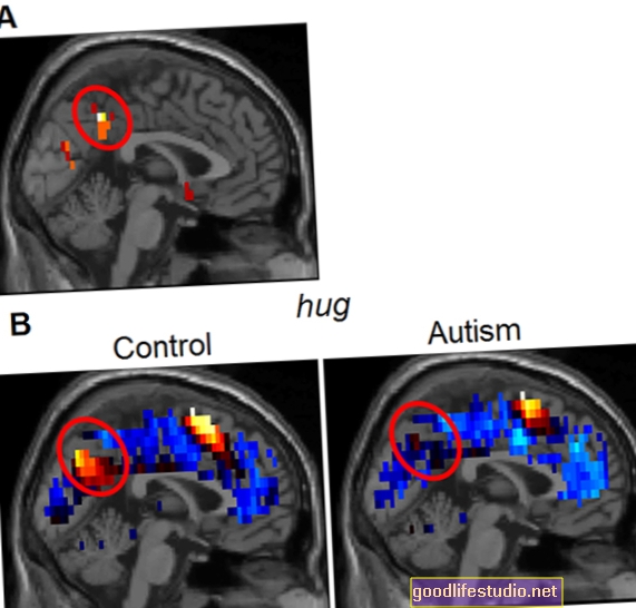 يمكن أن يشخص تصوير الدماغ التوحد عند معظم الأطفال