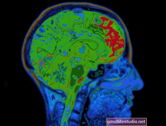 Pencitraan Otak Dapat Membantu Meramalkan Pemulihan dari Gegar otak