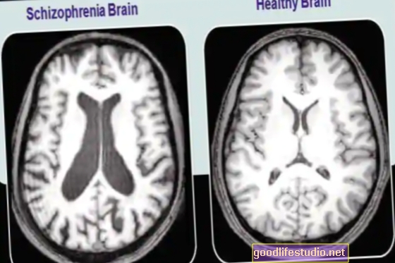 Образът на мозъка показва, че шизофренията може да не е едно заболяване