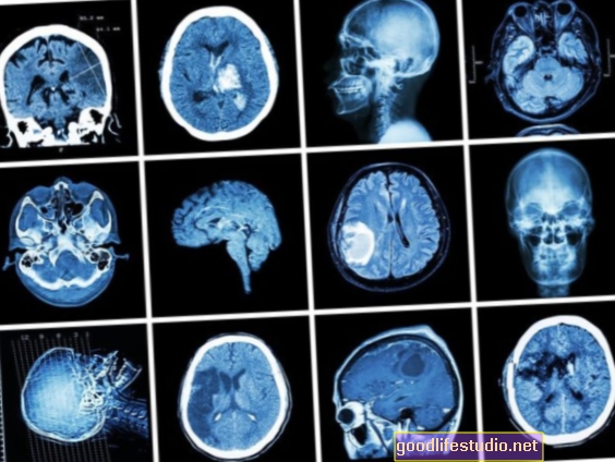 Zobrazování mozku se používá ke zlepšení protidrogových PSA