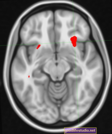 Сканування мозку може виявити реакцію антидепресантів