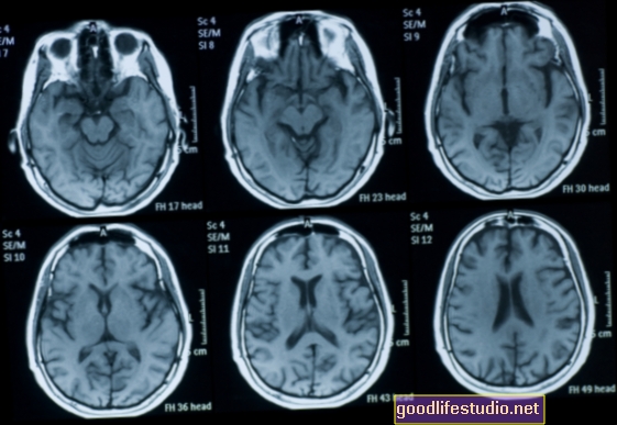 Der Gehirn-Scan kann die Reaktion des Patienten auf Antipsychotika vorhersagen