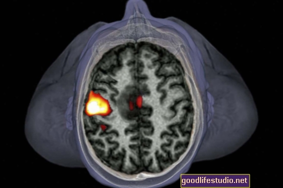 تهدف دراسة مسح الدماغ إلى تخصيص علاج اضطراب ما بعد الصدمة ليوم واحد