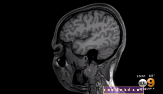 Une étude sur la scintigraphie cérébrale révèle plus d'un type de schizophrénie