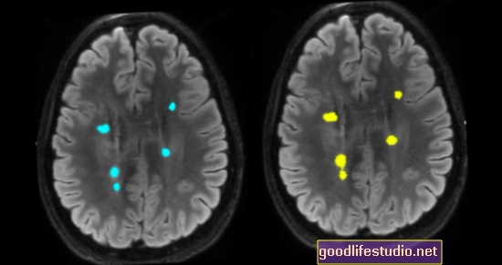 Сканування мозку, алгоритми, що використовуються для прогнозування ризику майбутнього психозу