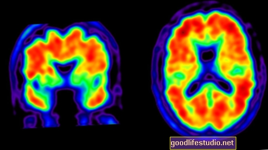 Smadzeņu skenēšana atklāj Alcheimera risku