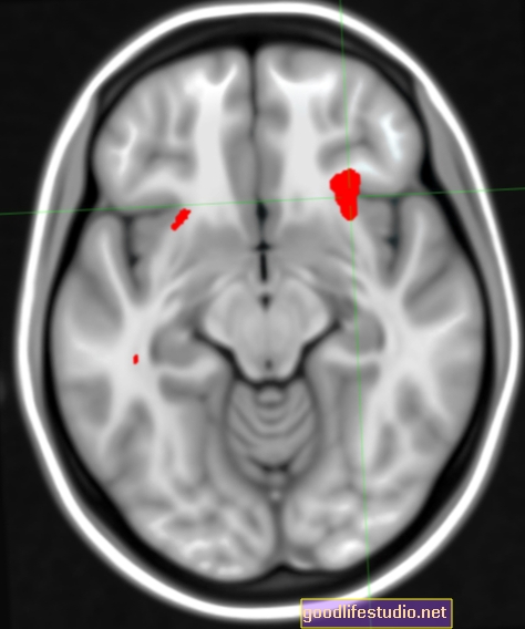 Los escáneres cerebrales ayudan a determinar el mejor tratamiento para el TOC