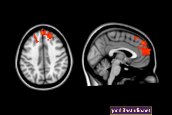 Gehirnscans können die Autismusdiagnose unterstützen
