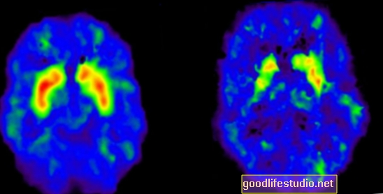 Smadzeņu skenēšana var palīdzēt paredzēt slaidu Alcheimera slimībā