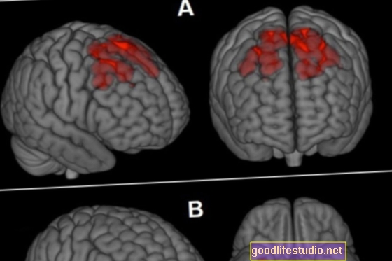 Сканування мозку може виявити ранні ознаки шизофренії