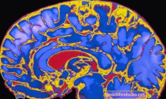 Smadzeņu skenēšana var izsekot bērnības psiholoģiskiem traucējumiem