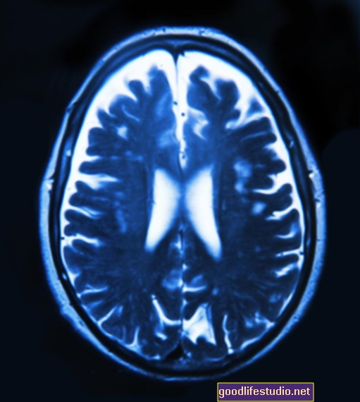 Gehirnscans zeigen die Auswirkungen der therapeutischen Hirnstimulation