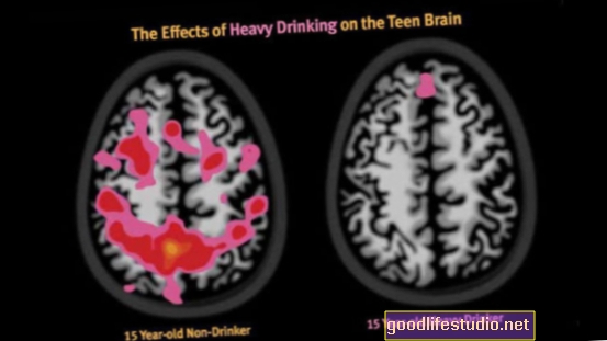 Skeniranje mozga pokazuje kako pijenje tinejdžera narušava učinkovitost mozga