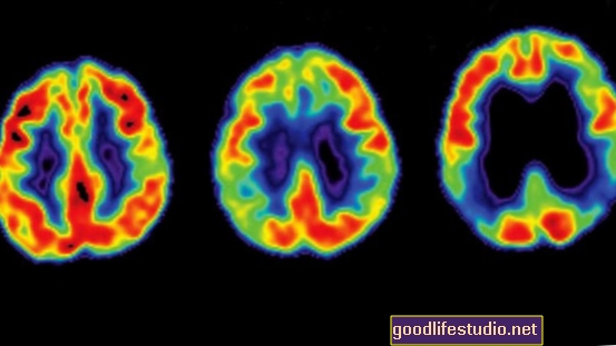 Les scintigraphies cérébrales suivent la progression d'Alzheimer