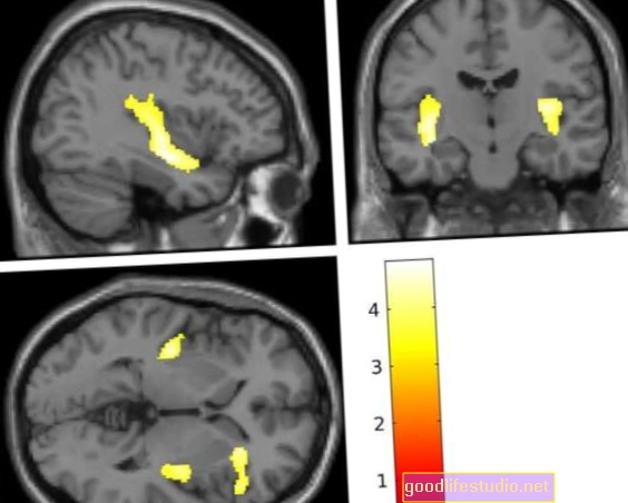 Smanjenje volumena mozga pronađeno kod dječaka tinejdžera s poremećajima u ponašanju