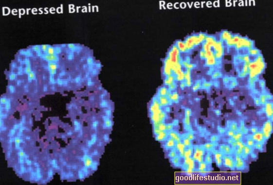 Cerebros de personas con depresión diferente