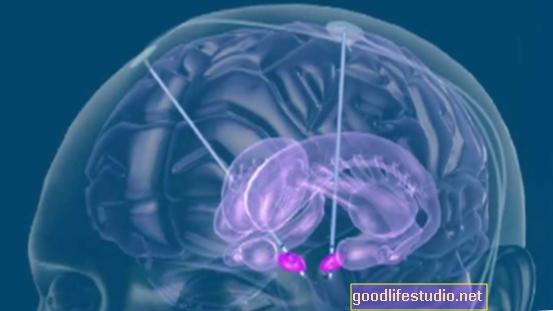 Globoka možganska stimulacija lahko olajša tike pri Severe Tourette