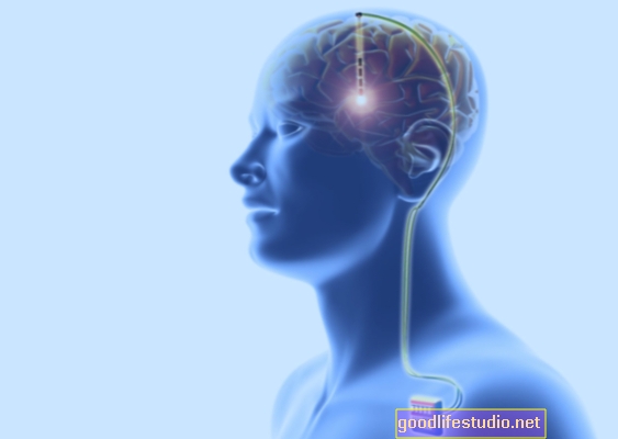 Dziļa smadzeņu stimulācija var pagarināt Parkinsona slimnieku dzīvi
