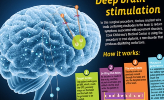 Dziļo smadzeņu terapija, ko sauc par “daudzsološu” smagai OCD