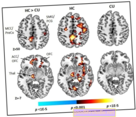 Ранна, редовна употреба на канабис, видяна за промяна на мозъчния регион, обвързан с когнитивния контрол
