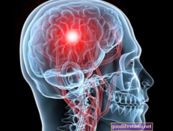 يغير العلاج بالصدمات الكهربائية مناطق الدماغ المسؤولة عن الذاكرة والعاطفة