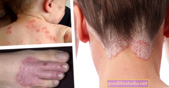 Eczema suferă mai mult decât pielea adâncă