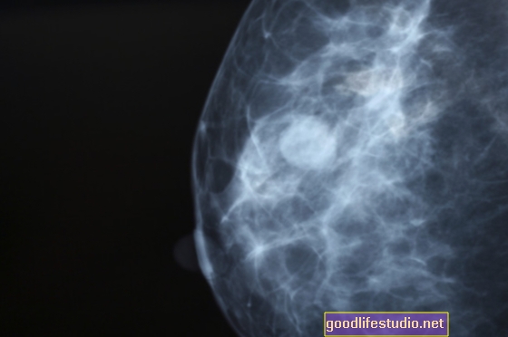 La mamografía falsa positiva es peor que la realidad para muchas mujeres