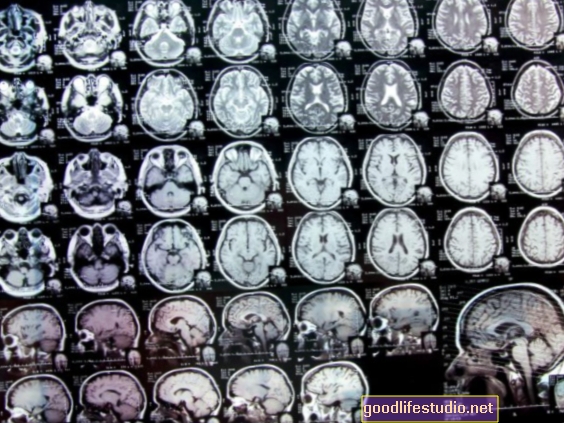 Gli studi di imaging possono migliorare la cura per l'ADHD