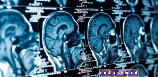 Zobrazovací studie Odkazy Strukturální změny mozku, kognitivní pokles u Parkinsonovy choroby