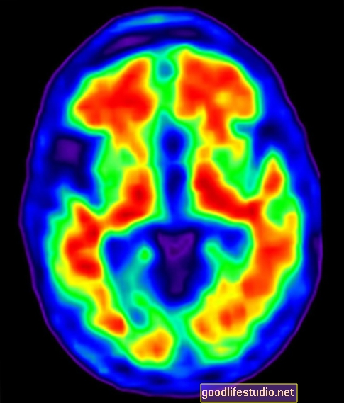 Une étude d'imagerie sonde l'activité cérébrale pendant les moments «Aha»
