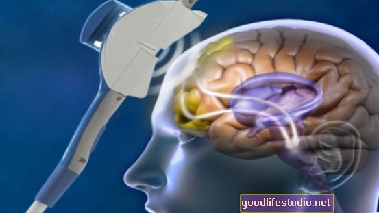 Магнетна стимулација мозга - рТМС - може побољшати меморију код шизофреније