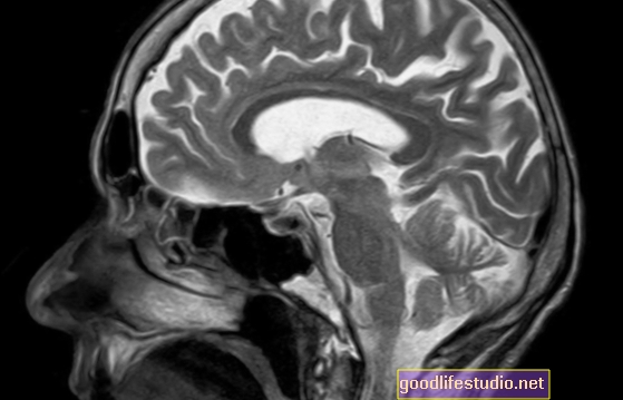Glavna študija skeniranja možganov osvetljuje vedenja OCD