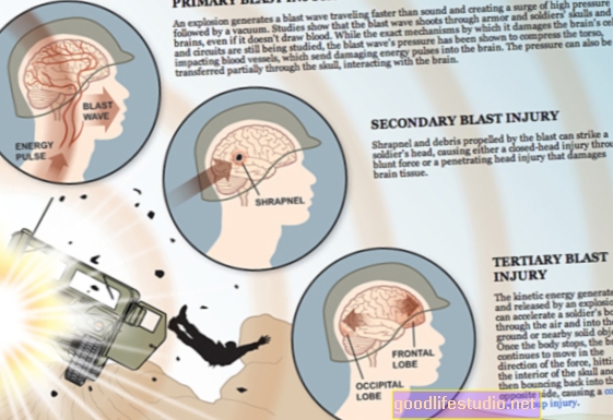 Kerge ajukahjustus võitluses võib põhjustada PTSS-i