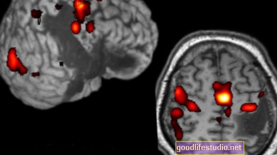 Mini-accident vascular cerebral poate duce la PTSD