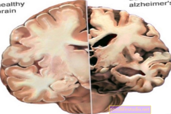 MRT kann auf Alzheimer untersuchen