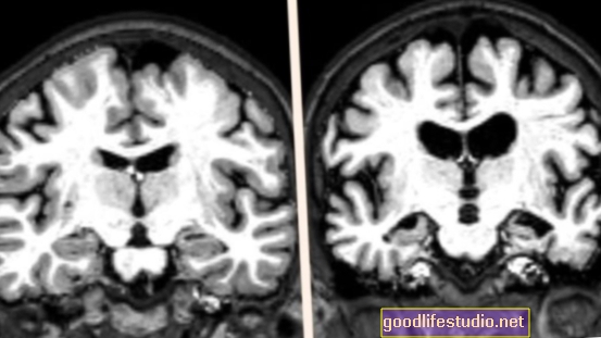 La resonancia magnética ayuda a detectar la enfermedad de Alzheimer antes de un daño mayor