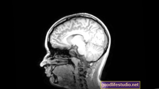 Le scansioni MRI rilevano la "ruggine cerebrale" nei pazienti con schizofrenia