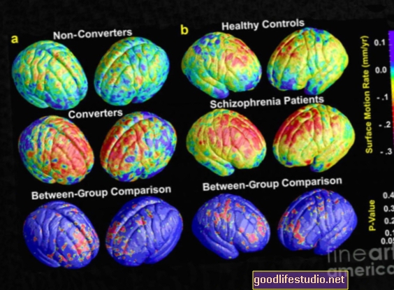 Le scansioni MRI possono predire il rischio di schizofrenia