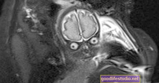 MRI näitab, kus õnn juhtub ajus