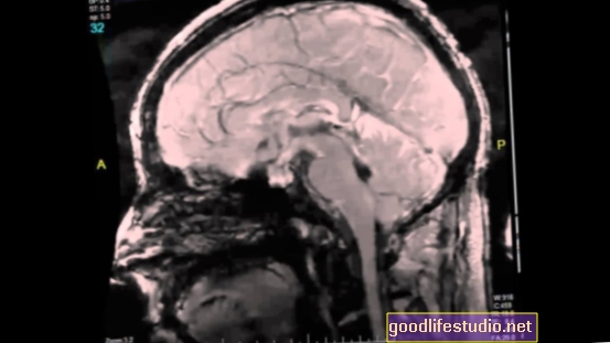 MRI uuring näitab bipolaarsete patsientide aju struktuuri erinevusi